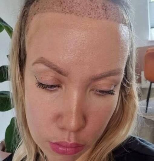 😲 Sonje van der Berg z Nizozemska podstoupila transplantaci vlasů – proměna, která šokuje!